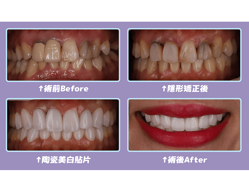 案例分享 隱形矯正