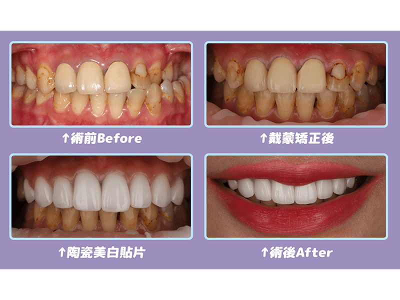 案例分享 戴蒙矯正